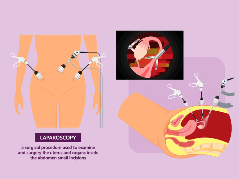 laparoscopic surgery for infertility treatment