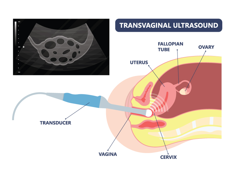 TVS Ultrasound Transvaginal Scan Test Cost | Fertility and IVF Centers