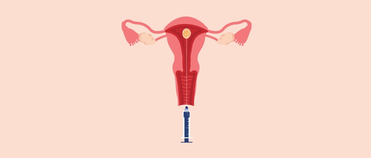 Positive Signs After Embryo Transfer