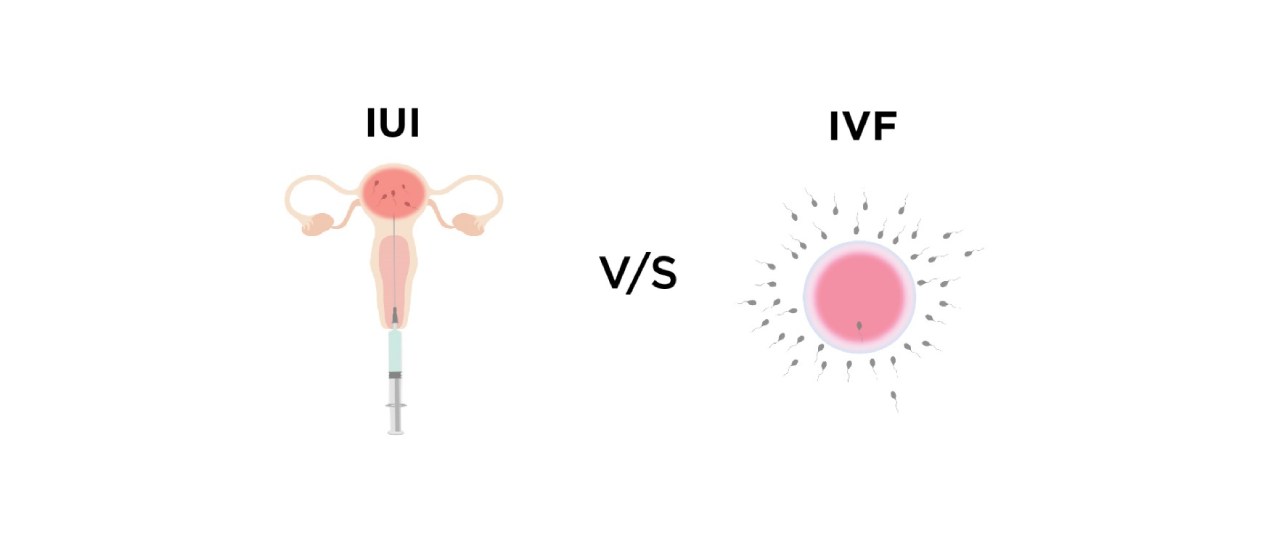 Difference between IUI and IVF