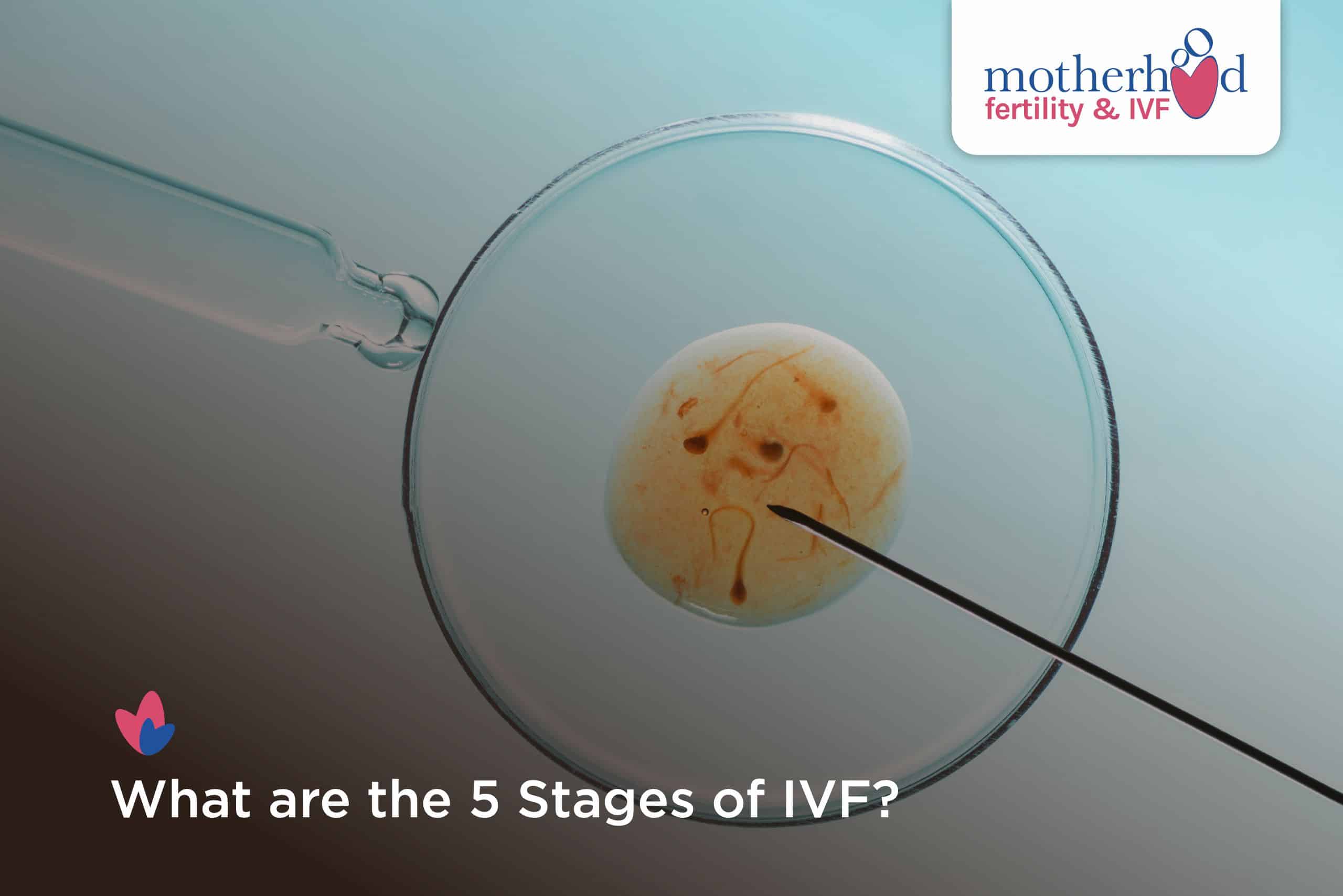 What are the 5 Stages of IVF?